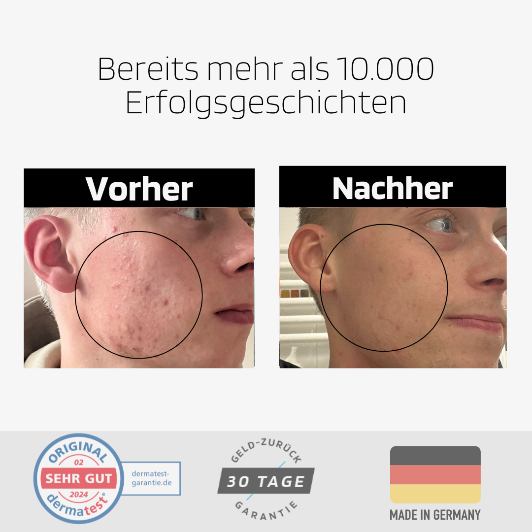 Anti Pickel Serum